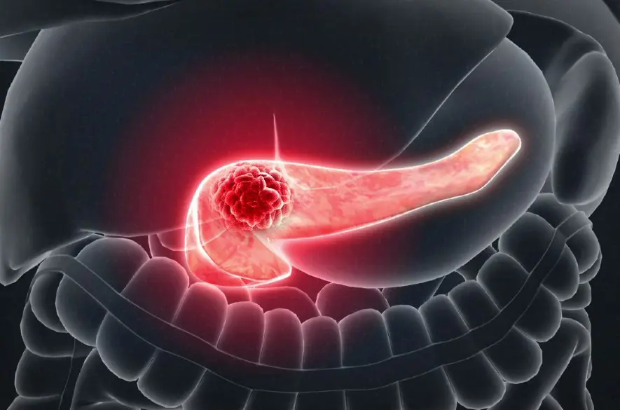 Tichý zabijak: 5 príznakov, ktoré vám pomôžu včas odhaliť rakovinu pankreasu