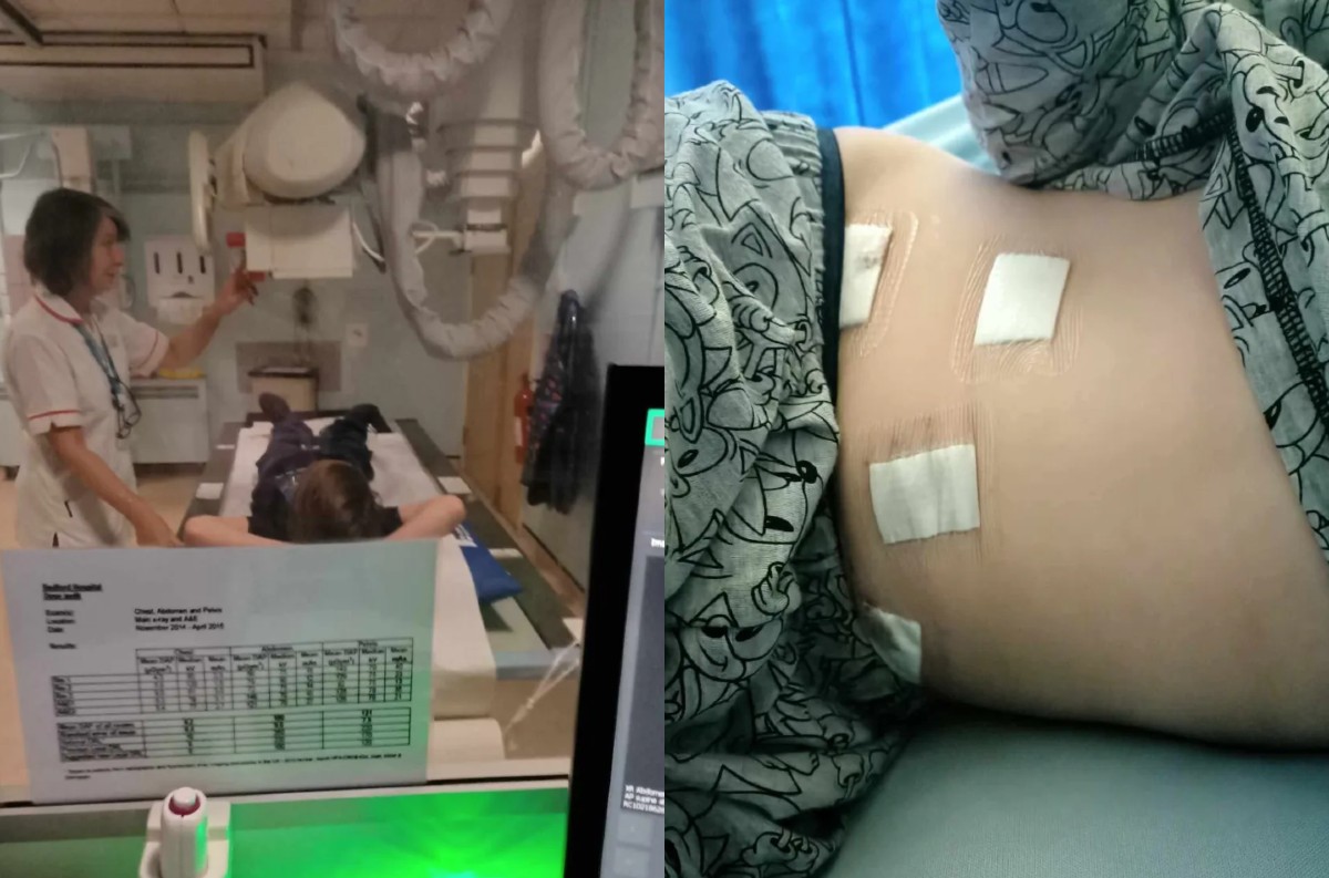 Dvanásťročný chlapec skončil v nemocnici pre TikTok trend. Toto mu takmer rotrhlo črevá!