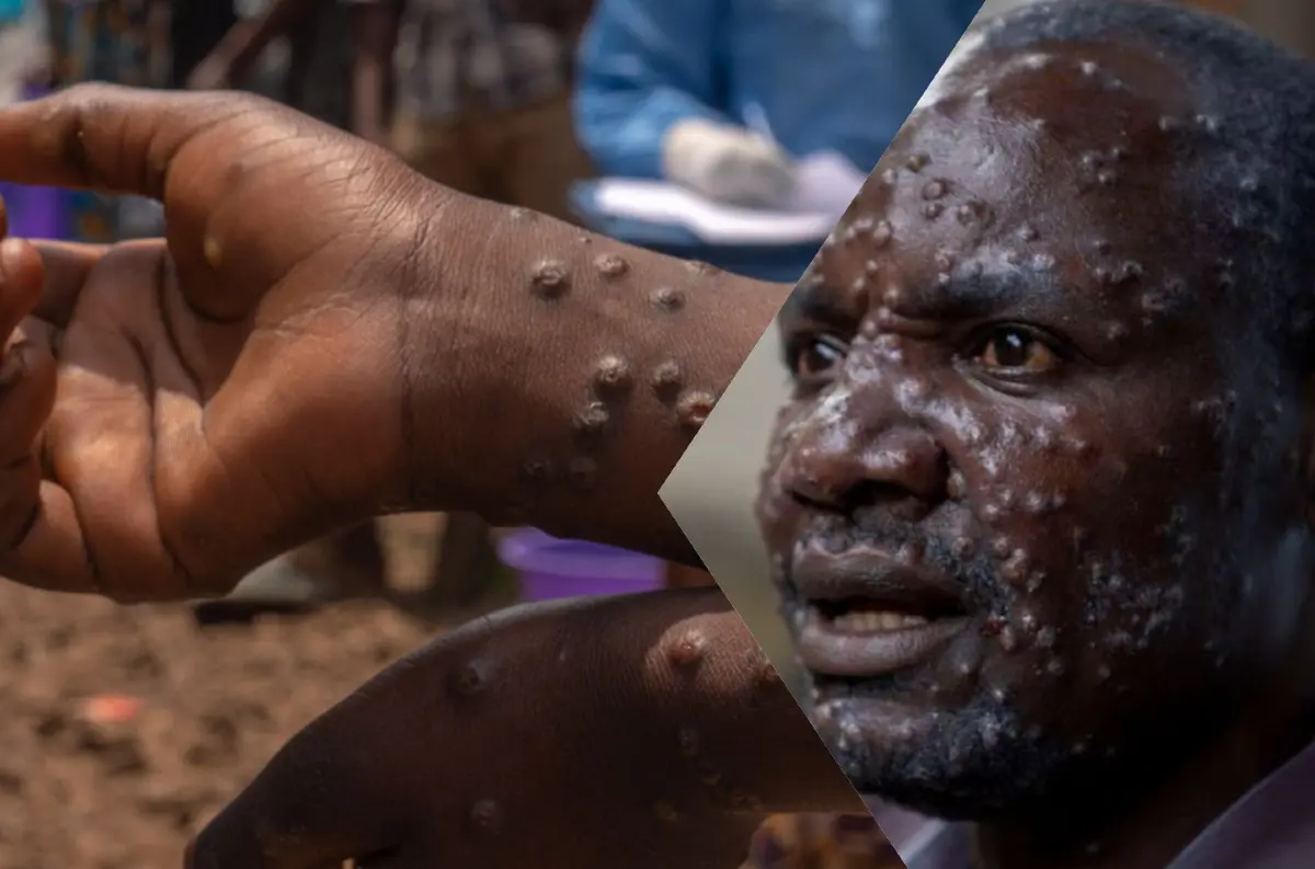 Mpox (opičie kiahne) na pokraji globálnej explózie: Vedci varujú pred pandémiou, hrozí mutácia