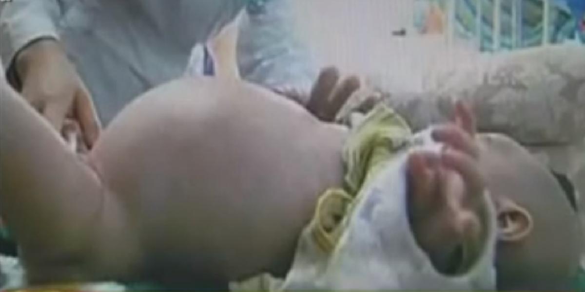Tehotný dvojročný chlapček, porodil svoje dvojča!