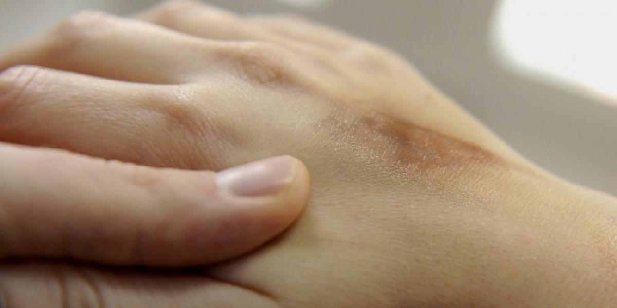 Pozor na psoriázu, za jej vznik môže aj stres