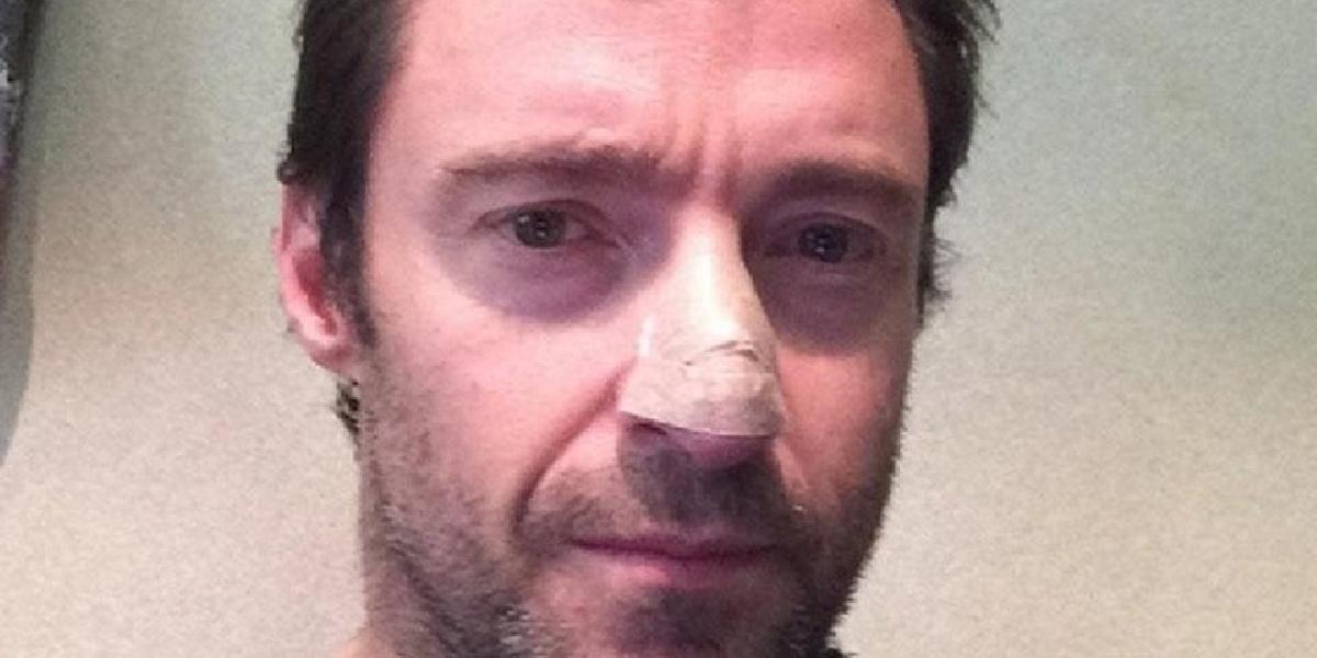 Herec Hugh Jackman sa liečil na rakovinu kože na nose