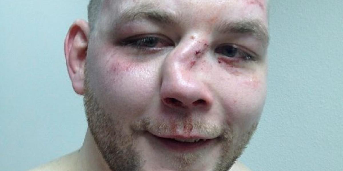 FOTO Vysmiaty zápasník s neuveriteľne zlomeným nosom