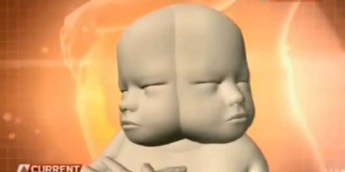 FOTO Žene sa má narodiť dieťa s dvomi tvárami!