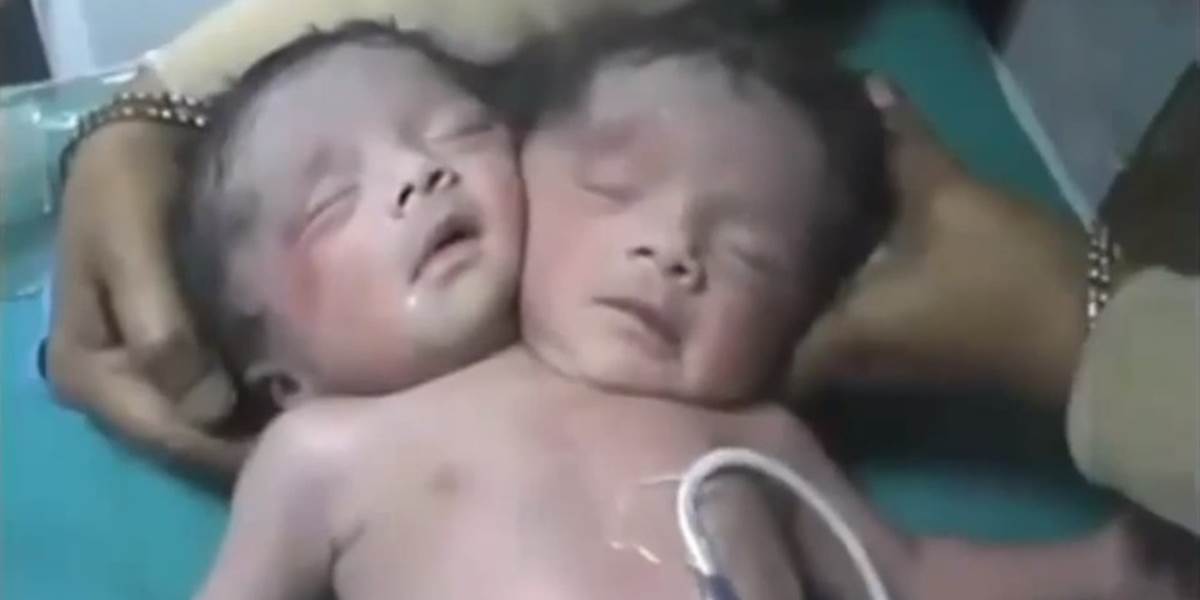 VIDEO Žena porodila dieťa s dvomi hlavami!